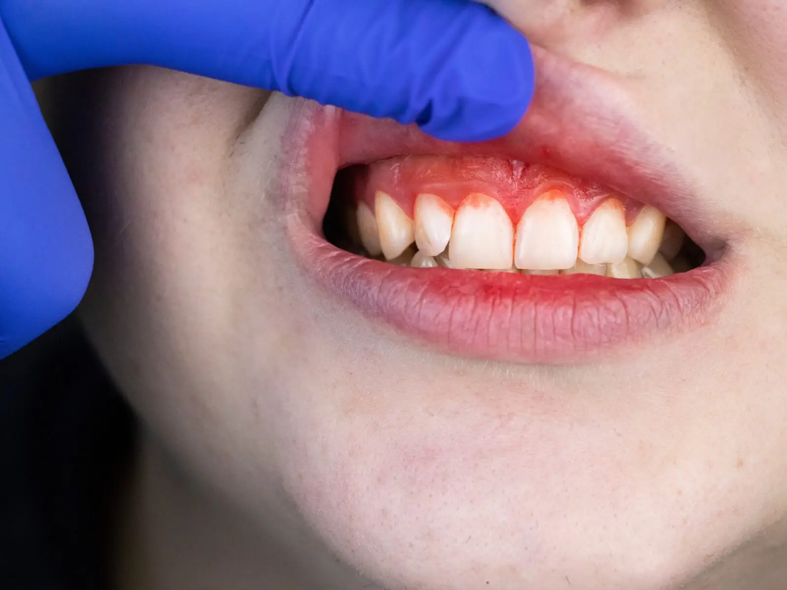 Revisión de encías sangrantes en clínica dental de Madrid